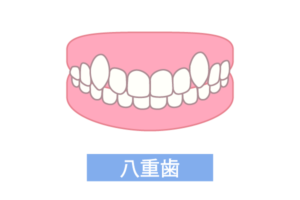 八重歯