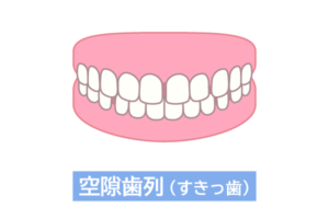 すきっ歯