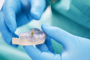 インプラント治療のメリット・デメリット