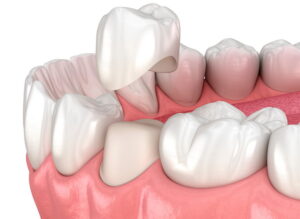 セラミッククラウン
